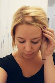 Alopecia1