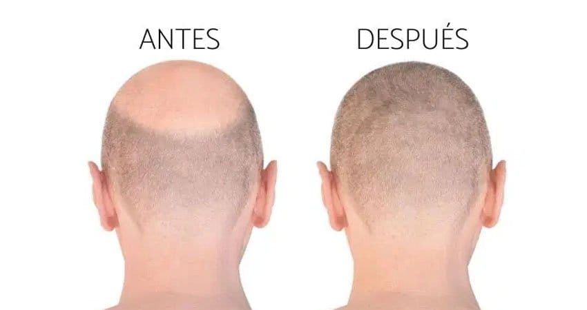 Injerto Capilar en famosos