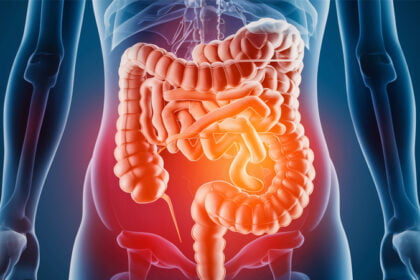 Enfermedades inflamatorias intestinales